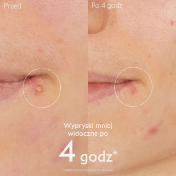 Kremy na dzień Vinopure Salicylic Spot Solution 